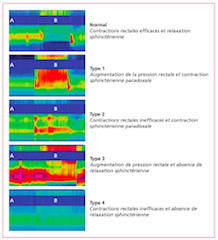 Manométrie anorectale à haute résolution