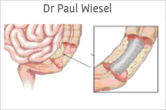 Endoprothèse